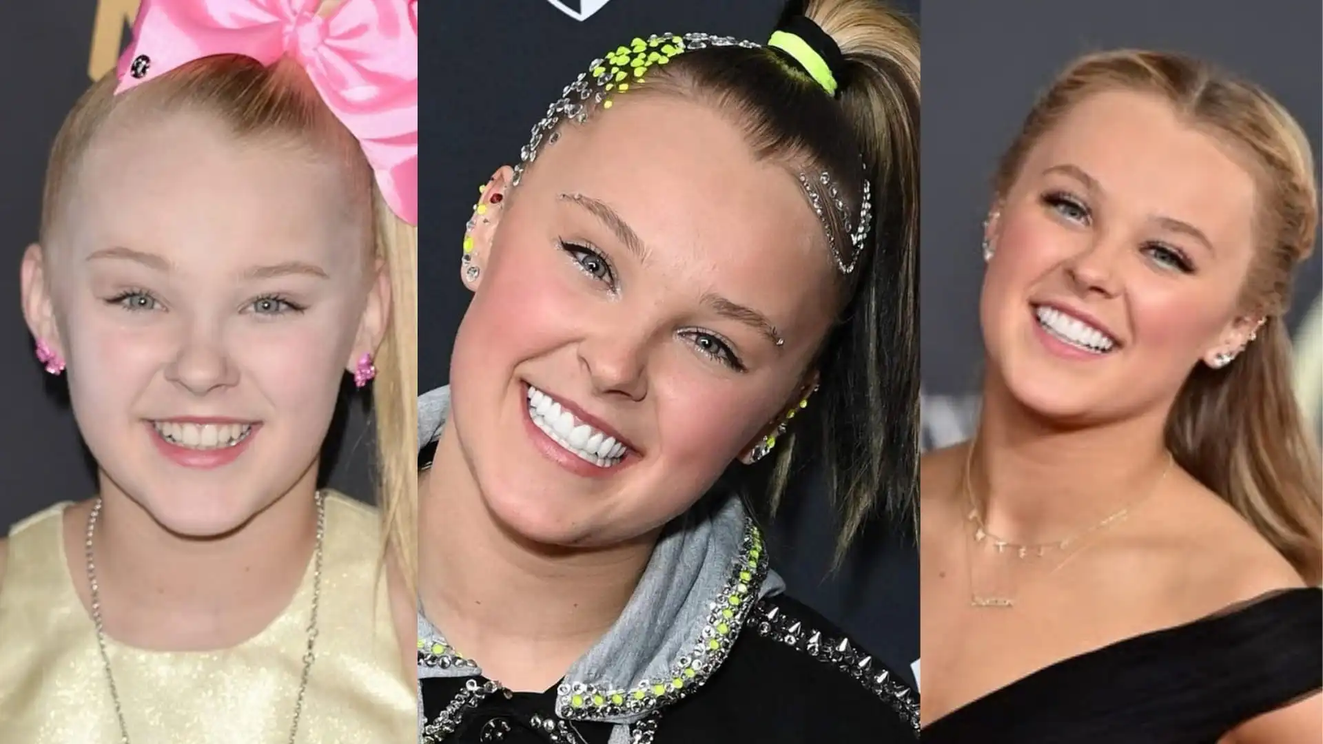 JoJo Siwa teeth veneer